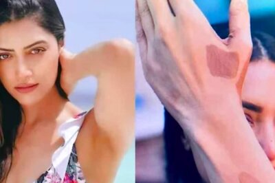 'Some Chocolate To Touch That Sky': Actress Mamta Mohandas' Message On World Vitiligo Day