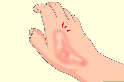 How to Determine if a Burn Is Infected