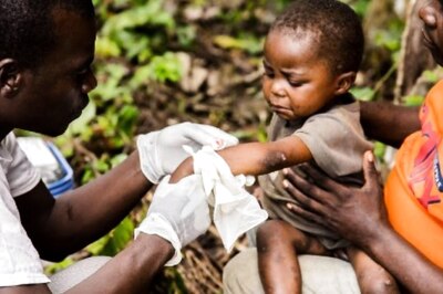 Is Monkeypox Severe In Children? Here is What Parents Should Know