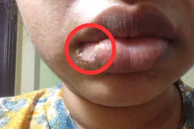 Hyderabad Dental Hospital Under Fire Again Following Viral Post About Woman's 'Chopped' Lip