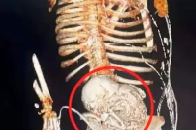 81-year-old Brazilian Woman Dies After Surgery To Remove Foetus She Carried For 56 Years