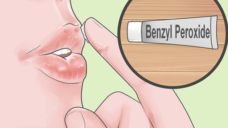 How to Treat Acne Around the Lips Fast